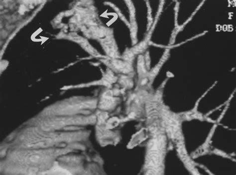 Incidentally Detected Cardiovascular Abnormalities On Helical CT