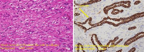 Pathology Slides Two Pictures Show The Pathological Findings Of The