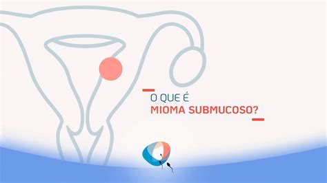 O Que Mioma Submucoso Dr Augusto Bussab Reprodu O Humana