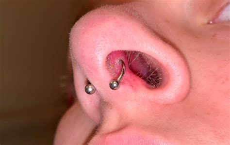 Septum Piercing Infection Causes And Treatment 58 Off