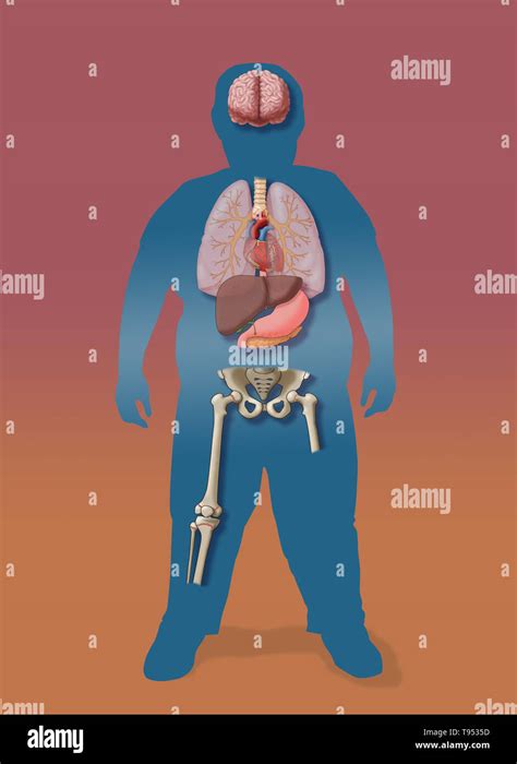 Una ilustración de las consecuencias médicas de la obesidad infantil