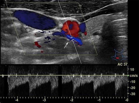 Normal Ultrasound Anatomy And Common Anatomical Variants Of The Thyroid