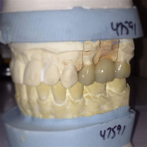 How can a fixed bridge replace a missing tooth? - Seasons of Smiles Dental