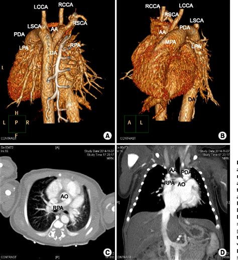 Figure 1 From Right Aortic Arch With A Retroesophageal Left Subclavian