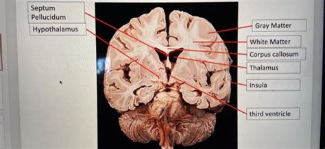 Septum Pellucidum And Lateral Ventricle