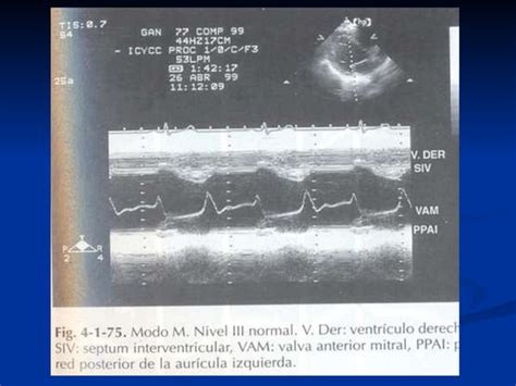 Cortes Ecocardiogr Ficos Ppt
