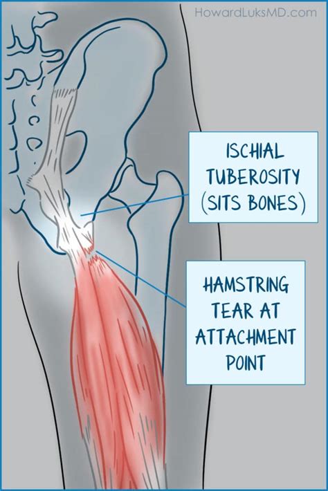 Proximal Hamstring Tendinopathy A True Pain In The Butt