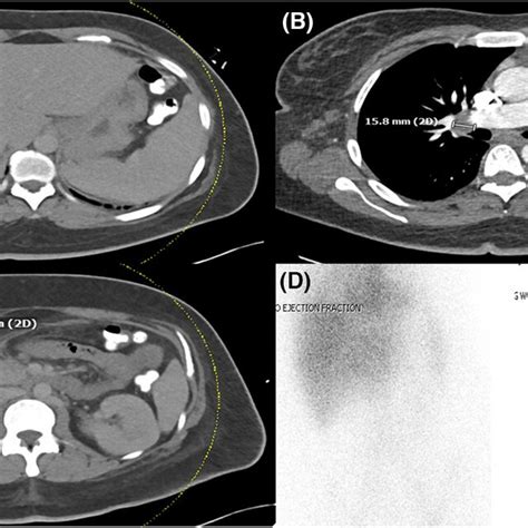 CT Scan Of A The Abdomen Depicting Splenomegaly B Of The Chest