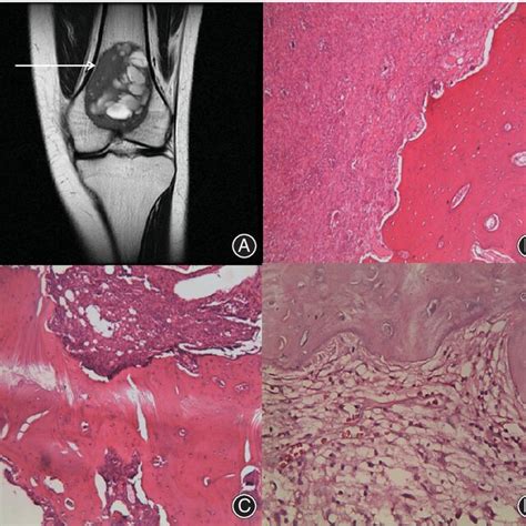 Giant Tumor Of Bone GCTB Located At Distal Femora A Arrow Refers