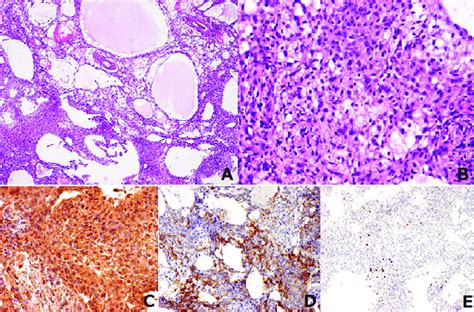 A B Histological Examination Indicative Of A Microcystic Meningioma Download Scientific