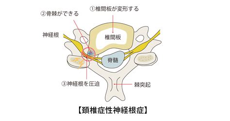 頚椎症性脊髄症とは｜病気の概要と脳神経外科医による手術の特徴を解説 東京脊椎・関節クリニック羽田