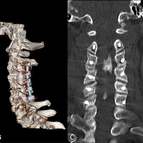 Pdf Clinical Application Of The C2 Pars Screw Technique In The