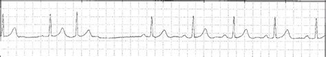 Supraventricular Ectopic Beat