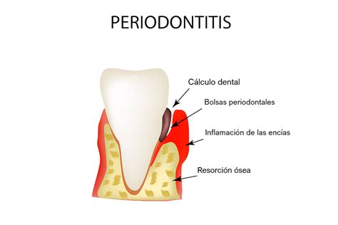 Periodontitis Cu Les Son Sus Tratamientos