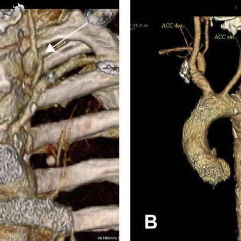 A And B D Reconstruction Computed Tomography Scan Showing A Left