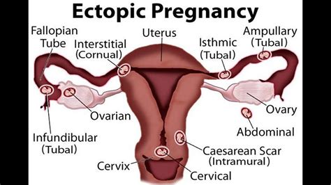 Cpt Code For Ectopic Pregnancy Surgical Treatment Simplify Medical