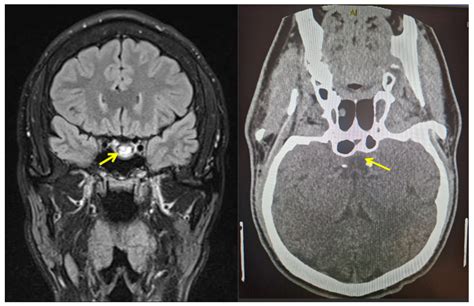 Biomedicines Free Full Text Pituitary Apoplexy In Patients With