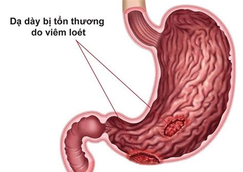 Viêm loét bao tử là gì Nguyên nhân và cách điều trị TCI Hospital