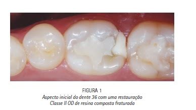 Uso De Resina Bulk Fill E Novo Sistema De Matriz Seccional Para