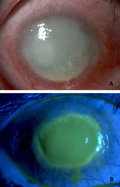 An Update On Acanthamoeba Keratitis Diagnosis Pathogenesis And Treatment Parasite