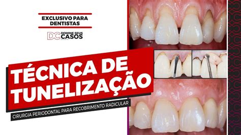 Técnica da Tunelização Cirurgia Periodontal para Recobrimento