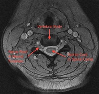 Normal Cervical Mri Axial