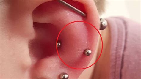 How To Get Rid Of Ear Piercing Swelling Youtube