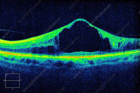 Diabetic Macular Oedema Oct Scan Stock Image C0570660 Science