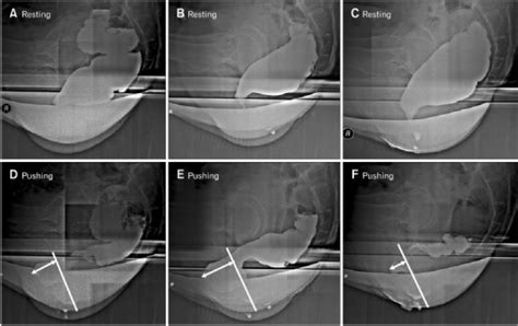 Fluoroscopic Defecography The Measured Size Of Rectoce Open I