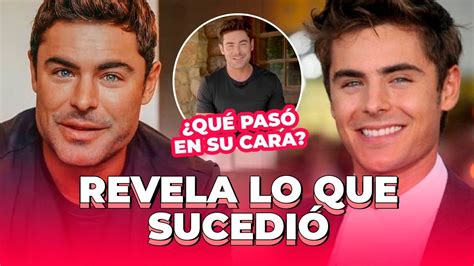 Zac Efron Revela Por Fin Lo Que Pasó En Su Cara ¿fue Cirugía Youtube