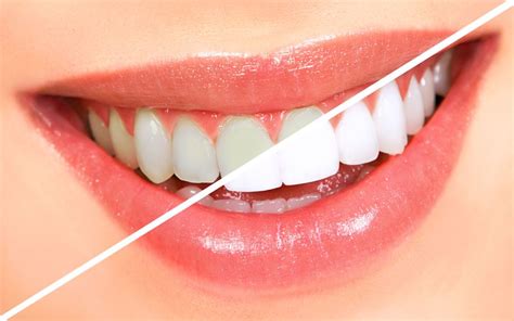 Debunking Four Most Common Teeth Whitening Myths Dr Alex Midtown Nyc Cosmetic Dentist