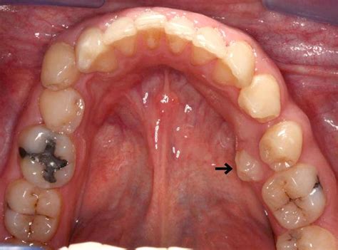 Intra Oral View Of The Mandibular Arch The Arrow Shows Lingually