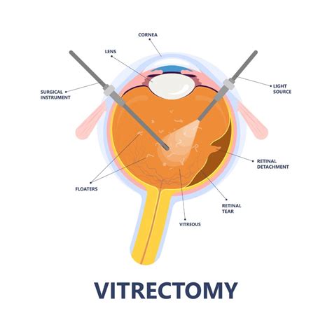 Retinal Detachment Orlando Retina Consultants Of Orlando