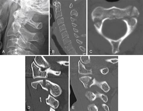 The Cervical Spine Radiology Key