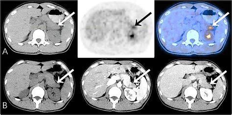 Frontiers The Value Of 18f Fdg Petct In Diagnosing Pancreatic