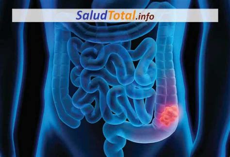 Que Son Los Pólipos Del Colon Causas Síntomas y Tratamiento