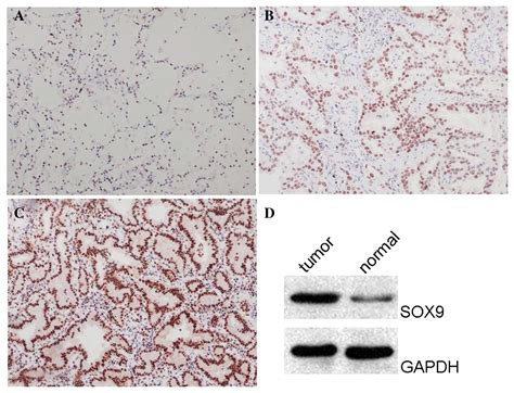 Upregulation Of Sox9 Promotes Cell Proliferation Migration And Invasion In Lung Adenocarcinoma