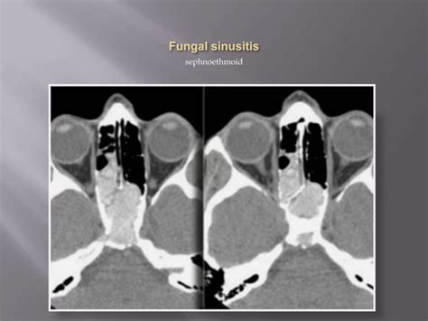 Sinonasal Polyposis Ppt