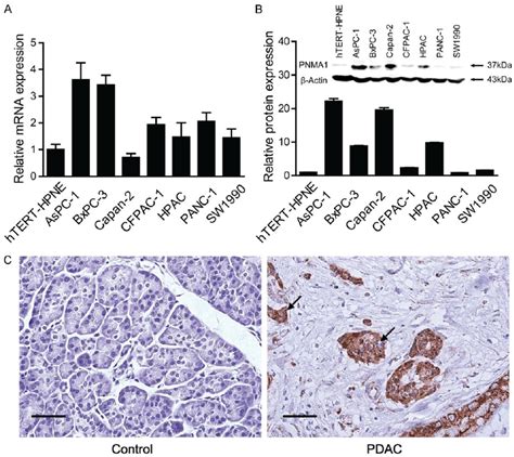 PNMA1 Expression Is Increased In Pancreatic Ductal Adenocarcinoma