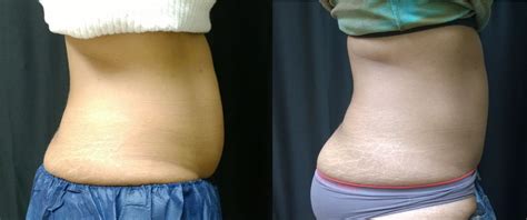 Coolsculpting Non Surgical Fat Reduction Lancaster Skin Center