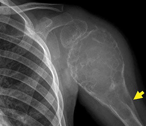 Telangiectatic Osteosarcoma • APPLIED RADIOLOGY