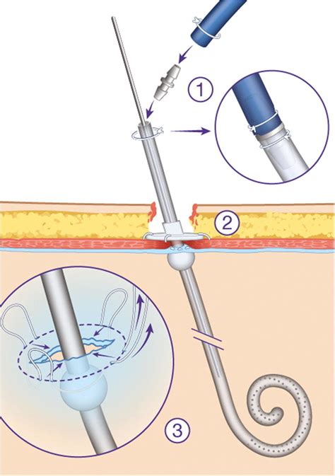 Peritoneal Catheter Placement Adaptation Of The Blue Catheter To