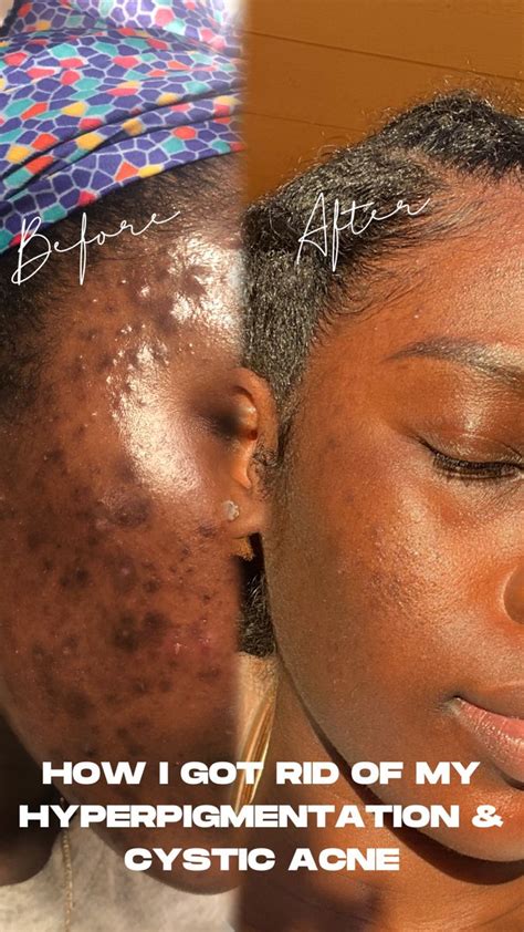 How I Got Rid Of My Hyperpigmentation Cystic Acne Hyperpigmentation