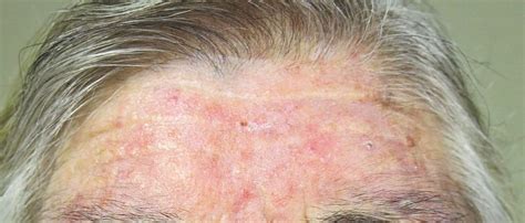 Dermatitis seborreica algo más que caspa