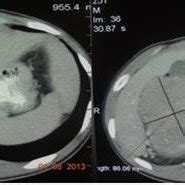 Abdominopelvic Cts At Showed Multiple Hypodense Foci In The Posterior