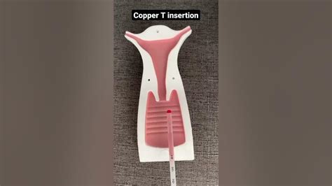 Copper T Insertion Youtube