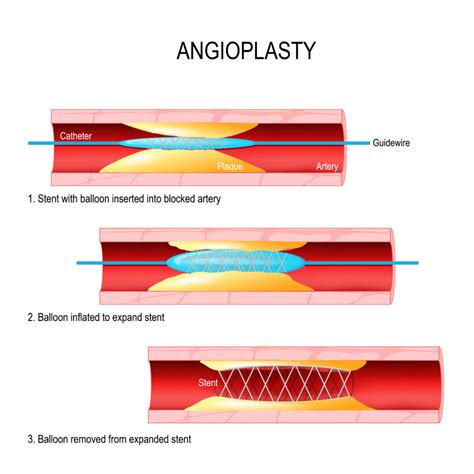 Percutaneous coronary intervention (or stent): Patient procedure guide