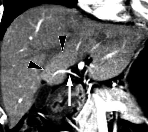 Hepatic Capsular And Subcapsular Pathologic Conditions Demonstration