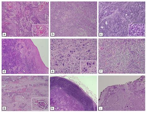 Histopathological Features Of Oscc Who Histological Differentiation