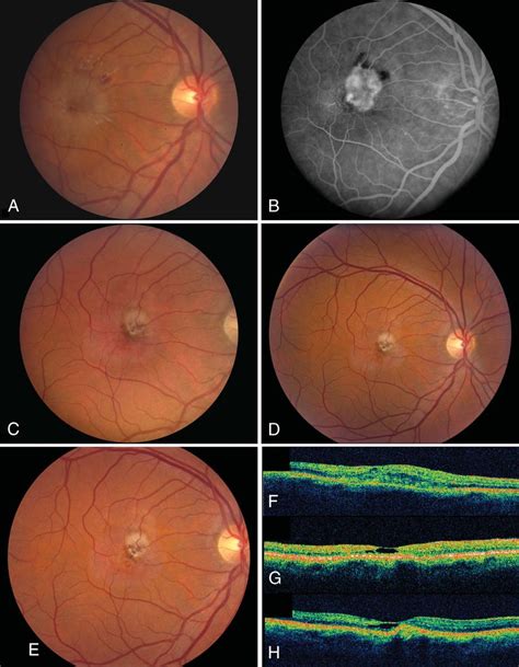 Treatment course of proliferative idiopathic MacTel Type 2 in Patient ...